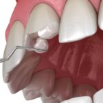 chipped tooth repair