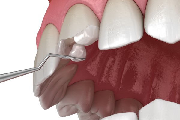 chipped tooth repair