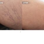 Can Veins Get Worse After Sclerotherapy