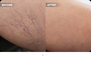 Can Veins Get Worse After Sclerotherapy