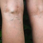 What is the latest treatment for varicose veins