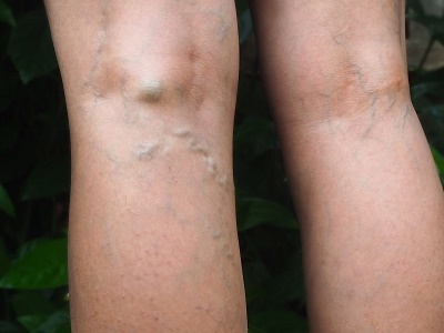 What is the latest treatment for varicose veins