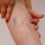 what to expect at a vein clinic