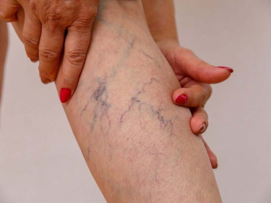 what to expect at a vein clinic