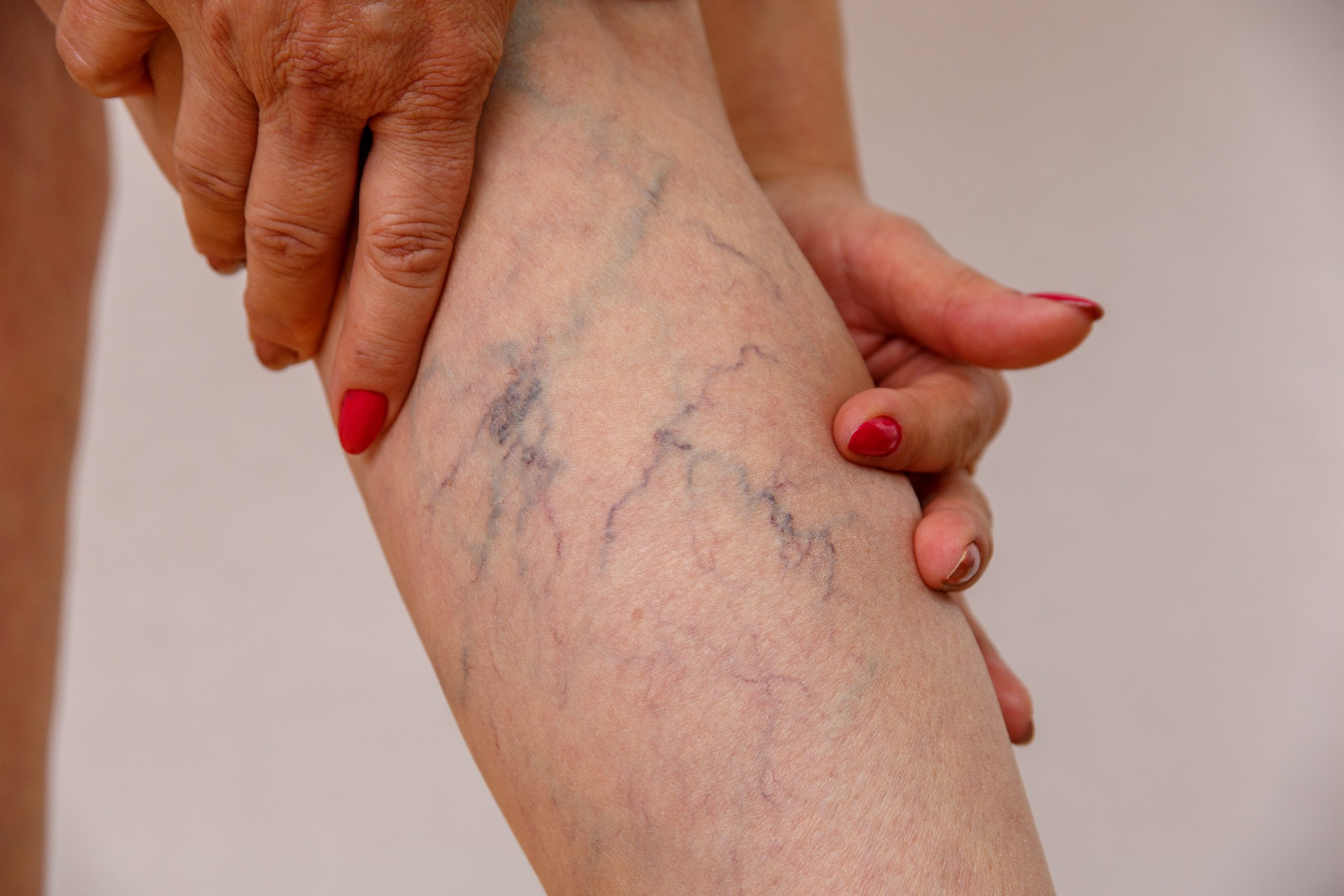 what to expect at a vein clinic