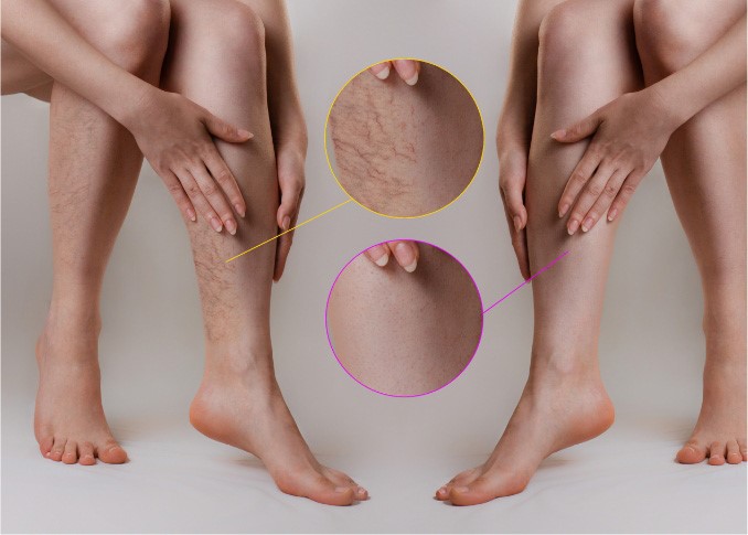 How can I get rid of varicose veins without surgery?