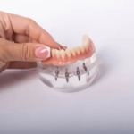 all on 4 dental implants cost macon ga