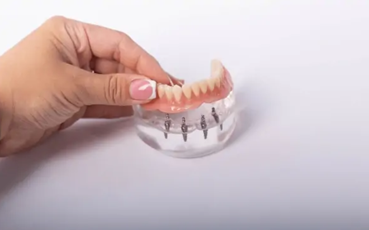 all on 4 dental implants cost macon ga