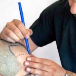 best hair transplant in lahore