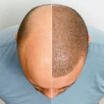 hair-transplant