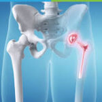 Top Hip and Knee Surgeons in Karachi: Profiles and Reviews