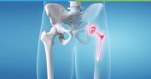 Top Hip and Knee Surgeons in Karachi: Profiles and Reviews