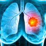 lung cancer specialist Singapore