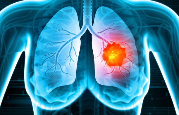 lung cancer specialist Singapore