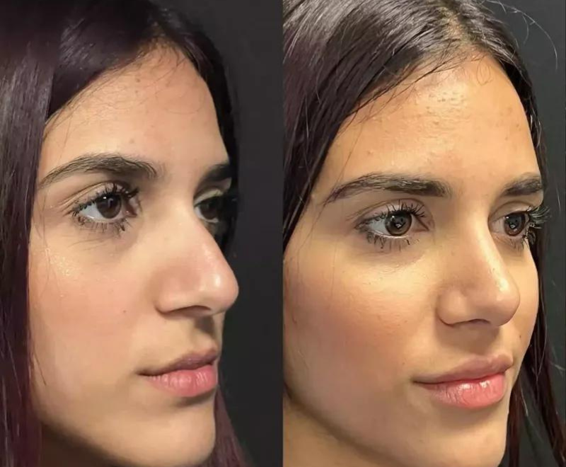 Rhinoplasty for Sports Injuries: Correcting Nasal Deformities in Dubai