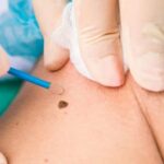 Top Keloid Scar Removal in London: Cost, Surgery, and Treatments in the UK