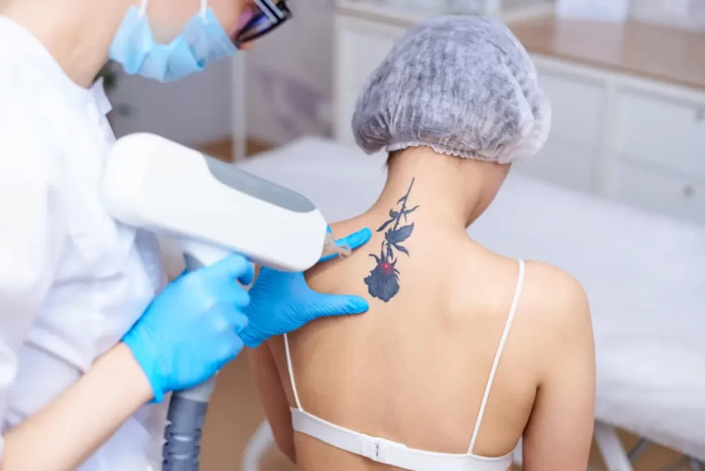 The Pros and Cons of Home Laser Tattoo Removal Machines