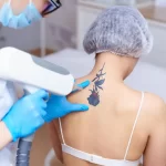 The Pros and Cons of Home Laser Tattoo Removal Machines