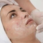 chemical peel treatment in Pakistan