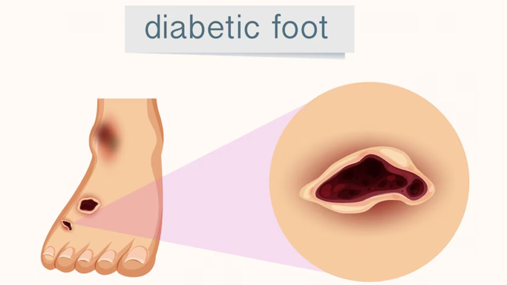 Balancing Flavor and Health: How Many Pizza Slices Fit into a Diabetic Diet?