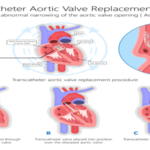 TAVR expert in India