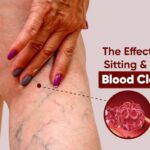 The Effect of Prolonged Sitting and Immobility on Blood Clot Formation