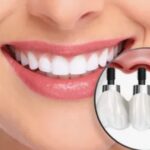 dental implants