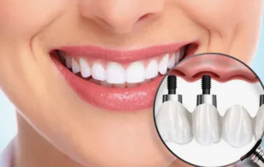 dental implants