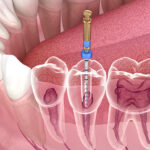 emergency root canal melbourne