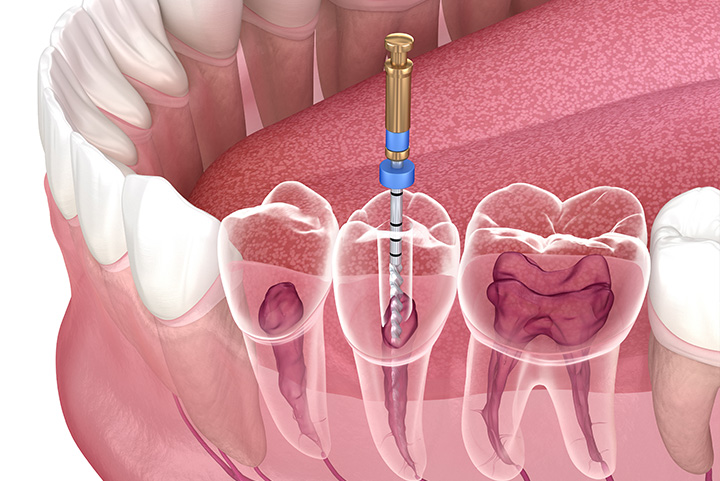 emergency root canal melbourne