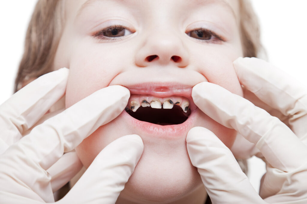 Beyond the Smile: Recognizing the Dangerous Health Effects of Skipping Dental Care