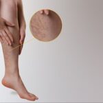 Is it worth getting varicose veins removed?