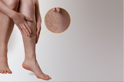 Is it worth getting varicose veins removed?