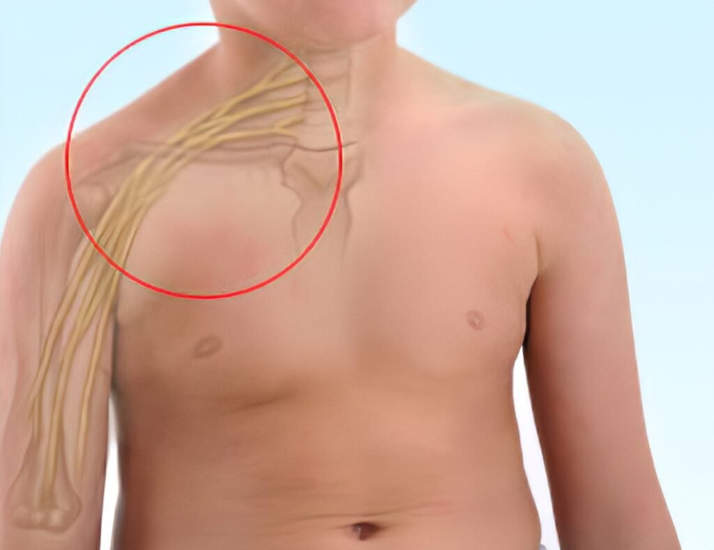 Brachial plexus surgery