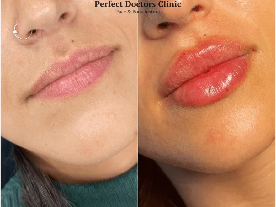 Juvederm Fillers