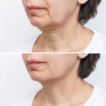 Achieve A Youthful Look With Neck Lift in London: Your Guide To Transformative Results