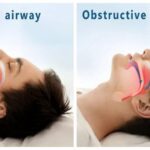 Sleep Apnea Diagnosis