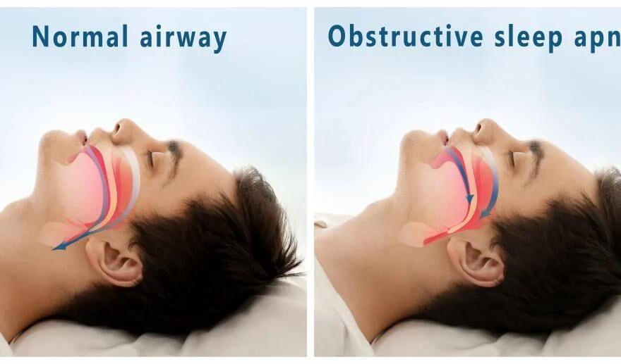 Sleep Apnea Diagnosis