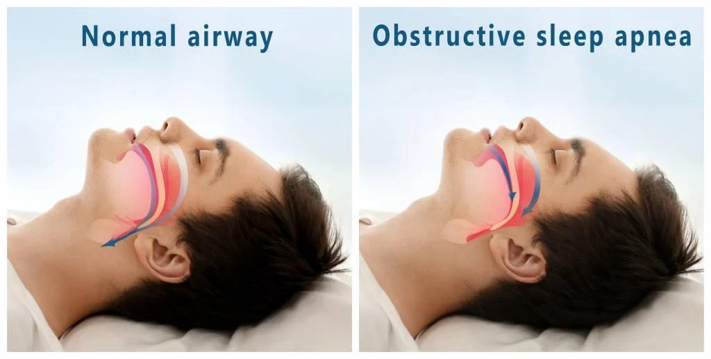 Sleep Apnea Diagnosis