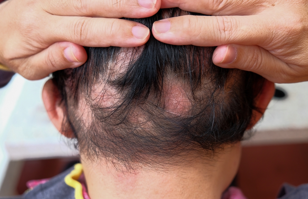 alopecia areata clinical trials in Indianapolis