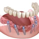 Full Mouth Dental Implants: A Comprehensive Solution for Restoring Your Smile