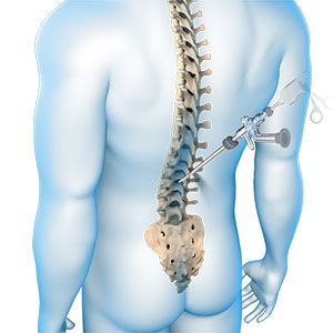 Spinal Tumor