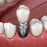 dental implant in cardiff