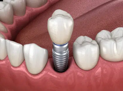 dental implant in cardiff