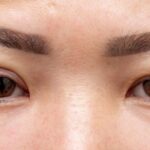 Achieve a More Youthful Appearance with Eyelid Surgery in Brisbane