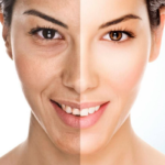 skin whitening treatment ahmedabad