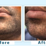 grey beard treatment, using natural remedies and professional solutions to restore beard color and maintain a youthful appearance