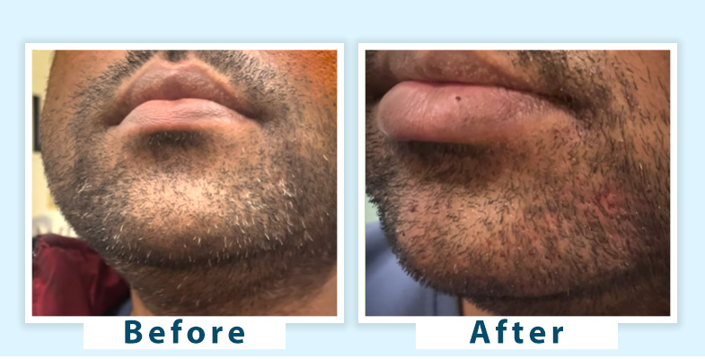 grey beard treatment, using natural remedies and professional solutions to restore beard color and maintain a youthful appearance