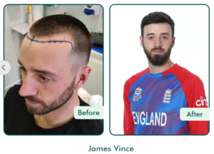 best hair transplant clinic london