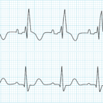 incomplete right bundle branch block symptoms